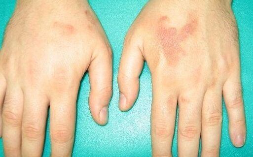 Il dolore alle articolazioni delle mani può essere un sintomo di parassiti