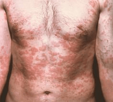 La pelle problematica è un sintomo della presenza di parassiti