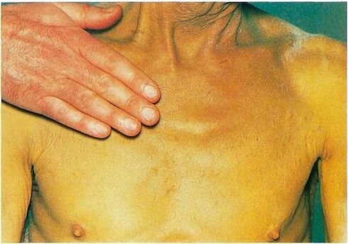 Ittero a causa di parassiti nel corpo